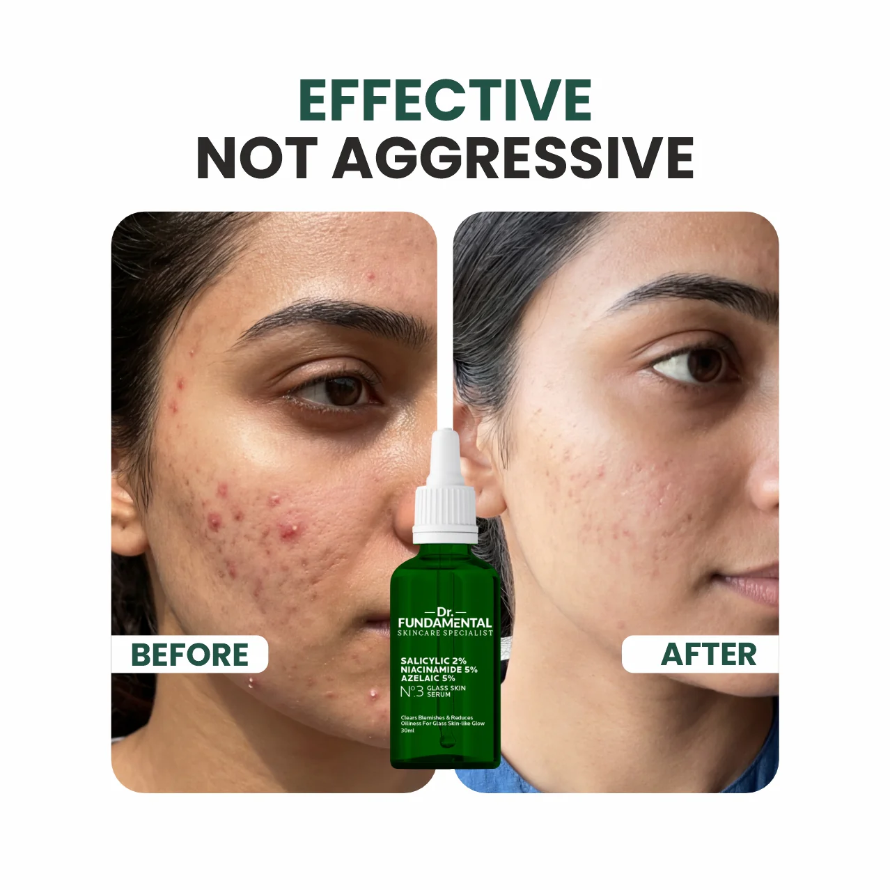 N0.2 Glass Skin Anti Acne Serum - Image 6